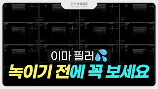 ⚠️이마 필러 녹이기 전에 꼭 보세요!  #초음파 #히알라제 [초이성형외과]