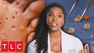 Dr. Ebonie Removes Over 200 Lesions From Patient's Feet! | My Feet Are Killing Me