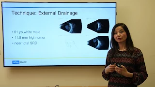 New Treatments for Ocular Melanoma | Tara McCannel, MD | UCLAMDChat