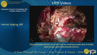 Pancreaticojejunostomy reconstruction for small pancreatic duct