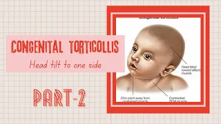 CONGENITAL TORTICOLLIS || PART-2 || WRY NECK || PATHOLOGY OF STERNOCLEIDOMASTOID || TWISTED NECK