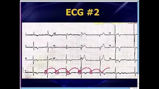 Amal Mattu's ECG Case of the Week_ May 5, 2014