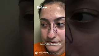 Correction Of Severe Crooked Nose Deformity | Dr. TAS