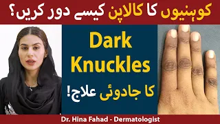 How To Treat Dark Knuckles? | Koniyo Ka Kalapan Kaise Dur Kare | Dr. Hina Fahad- Dermatologist