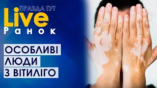 Не такий як всі – випробування вітиліго