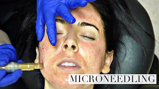 NIKKI GETS A NEW FACE Microneedling for acne scars!  BEFORE AND 6 MONTHS AFTER!