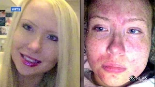 Woman Allergic to Her Own Sweat, Tears