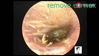 "Part 113 Remove Ear Wax Earwax Being Removed , Safely Remove Earwax at Home #short #earwax #earwax