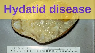 What is Hydatid Disease? - Pathology mini tutorial