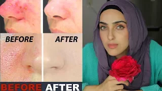 DIY Rose Spray For Tigher Pores + GLOWING Skin | 100% Effective ~ Immy