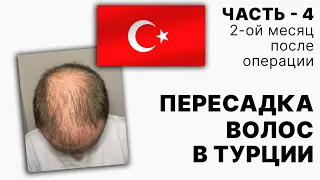 Пересадка волос в Турции. Часть-4 (2-ой месяц после операции)