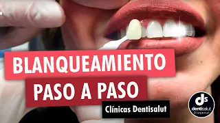 🦷😁 Blanqueamiento dental PASO A PASO 😁🦷 Antes y después - Clínica Dental Dentisalut