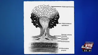 ESD: Japanese treatment for colon polyps catching on in the US?