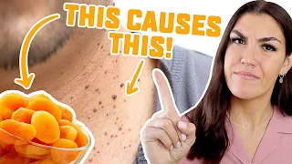 Stop Eating These 5 "Healthy" Foods That Cause Skin Tags! (Acrochordons)