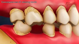 What are the consequences of missing teeth?