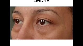 Lower Eyelid Blepharoplasty with Fat Repositioning, CO2 Laser