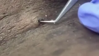 Ingrown hair