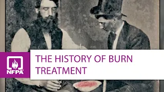 The History and Evolution of Burn Treatment