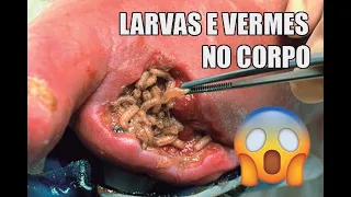 Larvas e vermes retirados do corpo humano