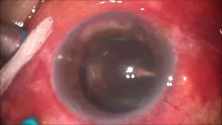 201904 Post Cataract Surgery Endophthalmitis -PPV + IVI antibiotics