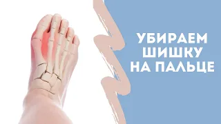 How to get rid of bunions. Without surgery.