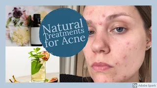 Natural Treatments for Acne | Best Acne Treatment | #Acne #skincare | Natural Home Remedies