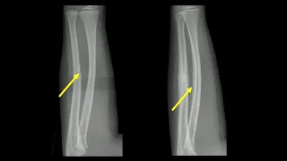Imaging Pediatric fractures