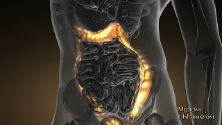 Prof. Gasbarrini Malattia Diverticolare: la complessità dietro una malattia apparentemente semplice