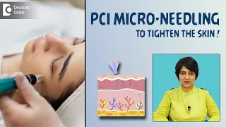 PCI Micro-needling| Skin Tightening Treatment| Making Holes in Skin -Dr.Rasya Dixit |Doctors' Circle