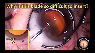 The effect of a bent blade tip for paracentesis creation during Cataract Surgery