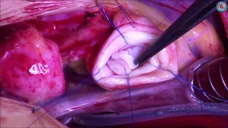 Unicuspid valve repair—what technique, which patch for which patient?