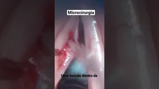 Microcirurgia de laringe : Cisto vocal