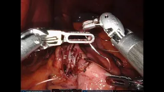 Robotic Gastric Bypass: Linear Stapler