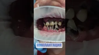 Зубы курильщика до и после операции. Smoker's teeth before and after surgery. Implantation.