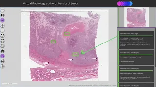 Testicular Seminoma