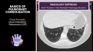 BASICS OF PULMONARY CONSOLIDATION: Case Example - Usual Interstitial Pneumonia (UIP)