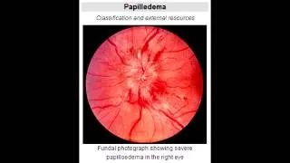 Papilledema - Define & Causes