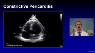 Treatment of Complicated Pericarditis