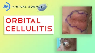 Virtual Rounds Session 8: Orbital Cellulitis (Premed Shadowing)