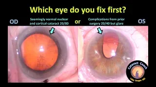 For complex cataract surgery, which eye do you fix first?