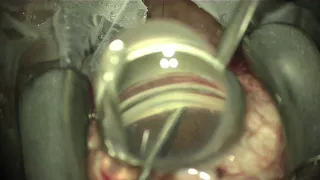 iStent Removal with Kahook Dual Blade Trabecular Meshwork Excision