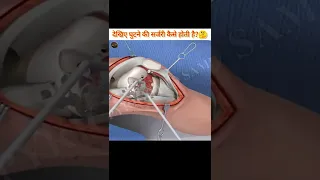 देखिए घुटने की सर्जरी कैसे होती हैं?🤔 || See how knee surgery is done. || #ashwanifactsworld #short