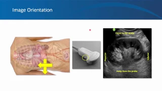 Renal ultrasound video 6, Quiz, University of Florida Nephrology, by Dr. Koratala (Twitter:@NephroP)