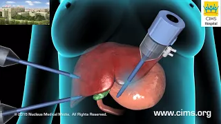 Cholecystectomy (Gallbladder Removal) - CIMS Hospital