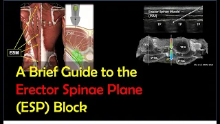 ESP Block - How To Perform It Effectively & Safely (2022)