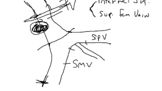 Cancer of the Pancreas: Whipple Procedure with Portal Vein Resection