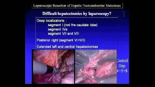 Laparoscopic Resection of Hepatic Neuroendocrine Metastases: Brice Gayet, M.D.