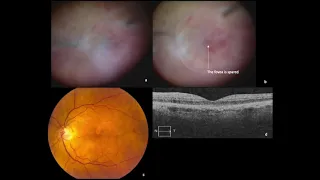 Complete and early vitrectomy for endophthalmitis - Video abstract [ID 253228]