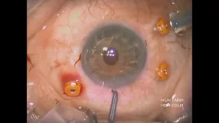 Retropupillary Artiflex® IOL for correction of aphakia - Video abstract ID 119347