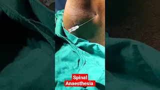 Spinal Anesthesia #shortsvideo #shorts #viral #trending #trendingvideo #nursing_gyan #youtubeshorts